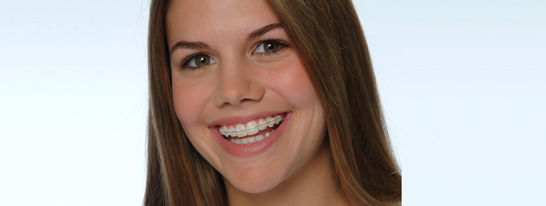 シンプル 違和感の少ないシンプルなワイヤーでお口の中を針金だらけにしない