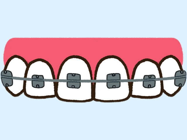 マルチブラケット法(エッジワイズ法)