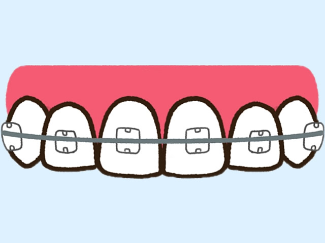 審美ブラケット