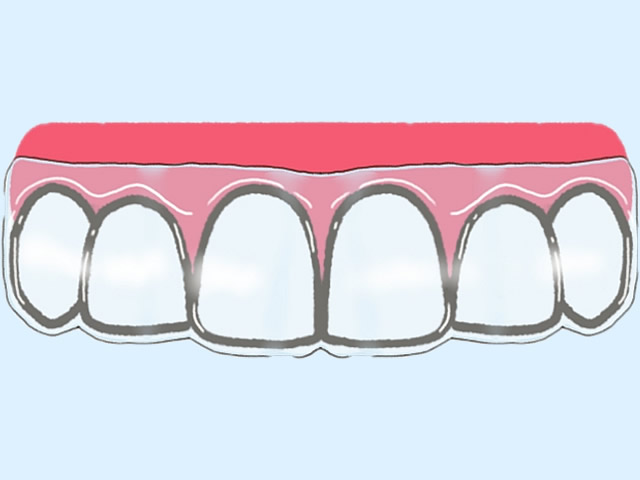 マウスピース(インビザライン、アライナーなど)