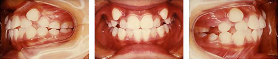 八重歯の治療例 矯正前