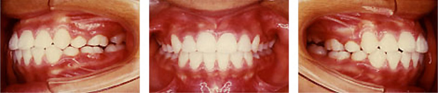 八重歯の治療例 矯正後