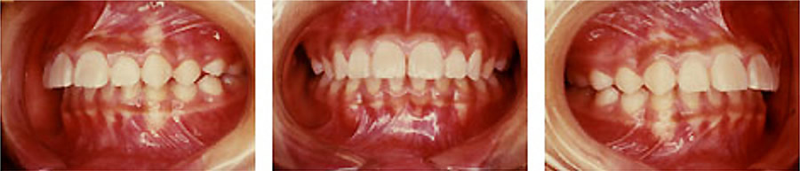 出っ歯の治療例 矯正前