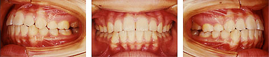 出っ歯の治療例 矯正後