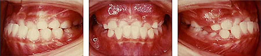 反対咬合の治療例 矯正前