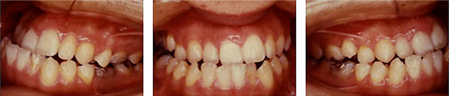 反対咬合の治療例 矯正前