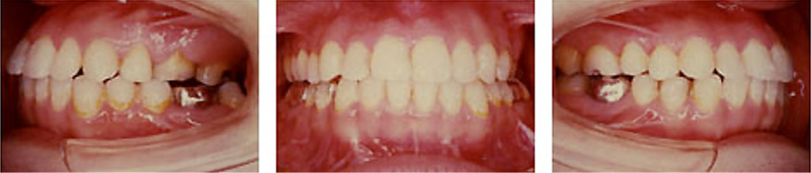 反対咬合の治療例 矯正後